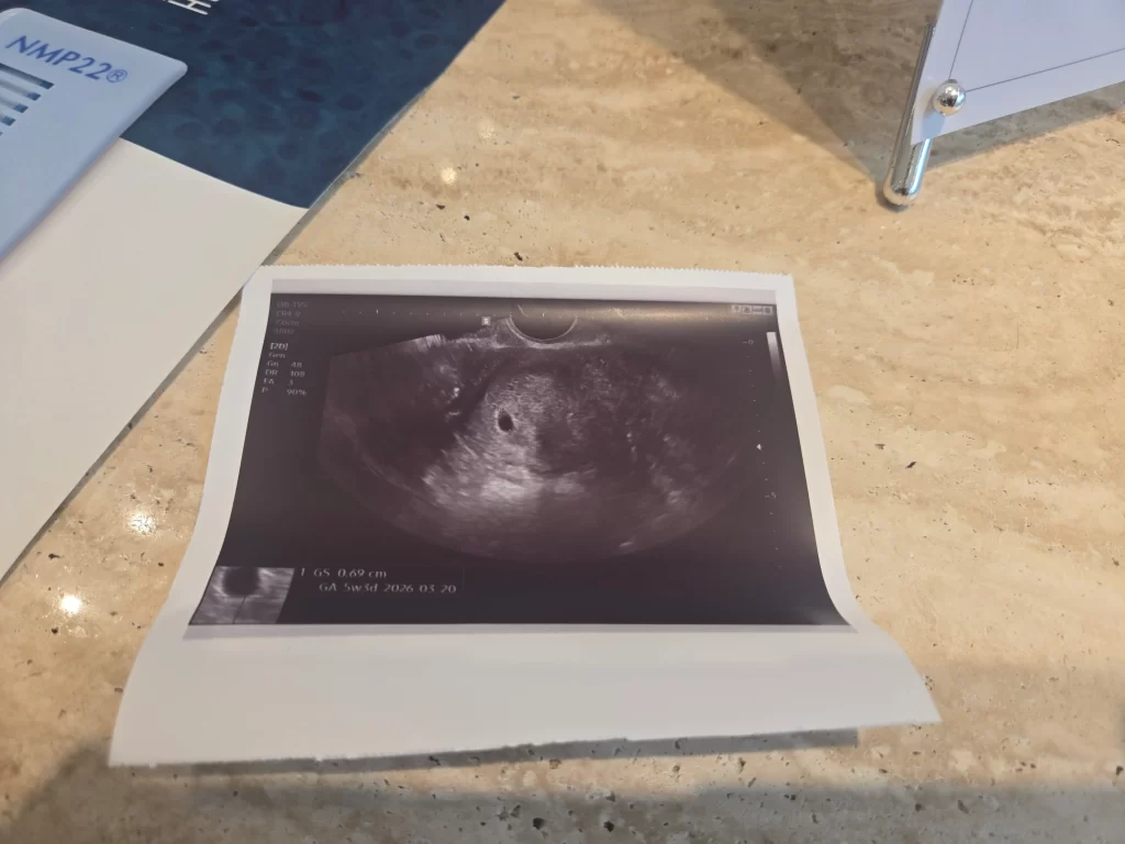 초음파 5주