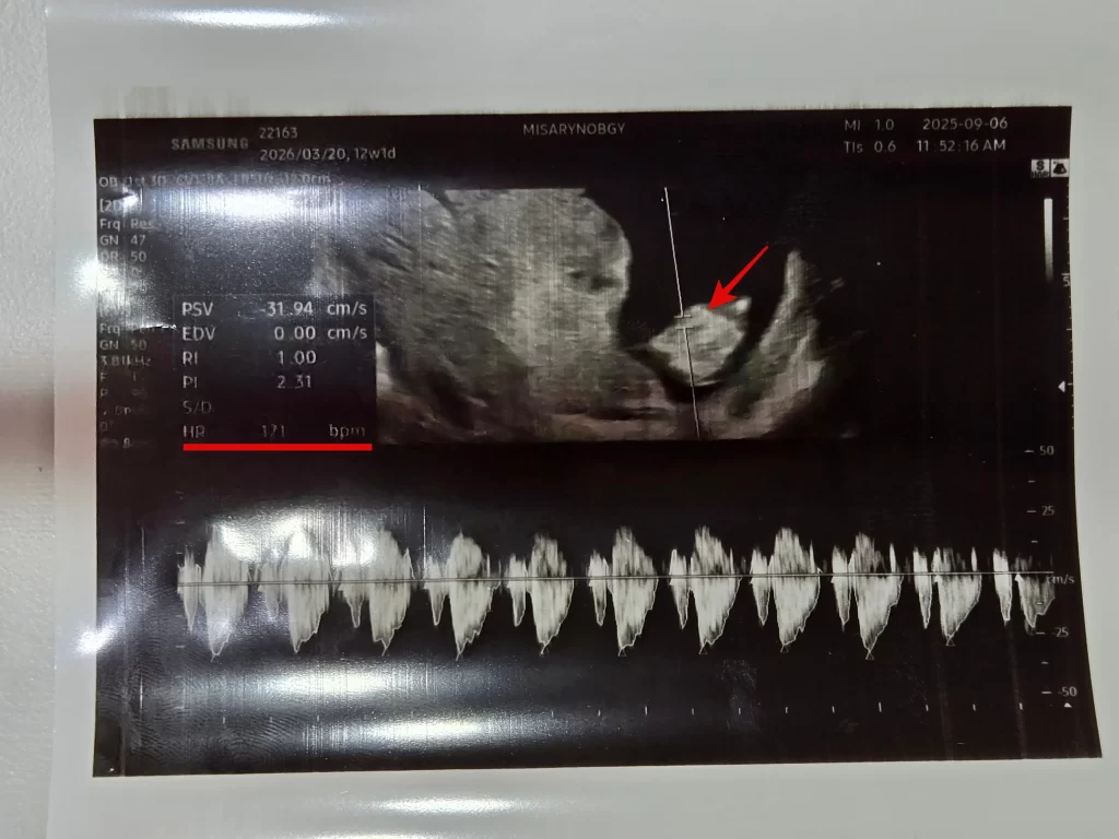 1차 기형아 검사1