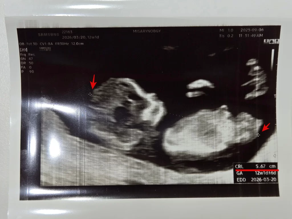 1차 기형아 검사2