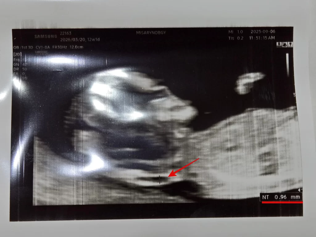 1차 기형아 검사3