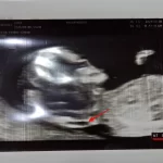 1차 기형아 검사3